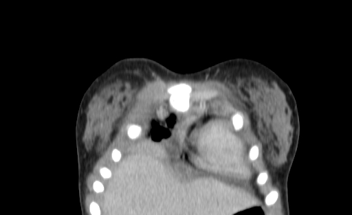Bronchial mucoepidermoid carcinoma (Radiopaedia 57023-63895 Coronal 1).jpg