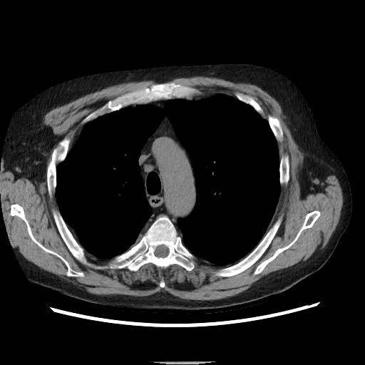 Bronchial stenosis - lung transplant (Radiopaedia 73133-83848 Axial non-contrast 20).jpg