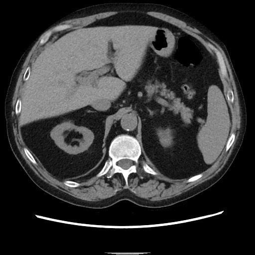 Bronchial stenosis - lung transplant (Radiopaedia 73133-83848 Axial non-contrast 60).jpg