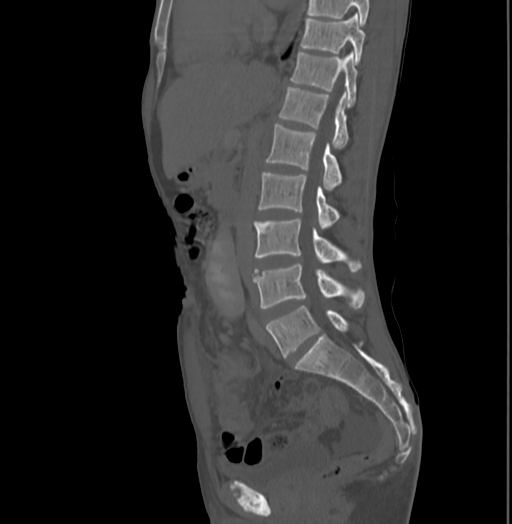 File:Bronchiectasis in Crohn disease (Radiopaedia 60311-67977 Sagittal bone window 116).jpg