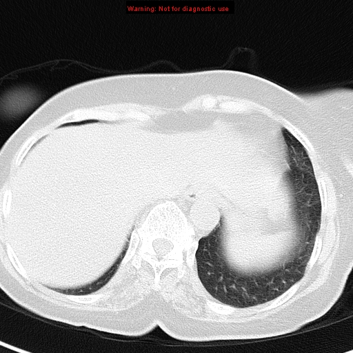 File:Bronchoalveolar carcinoma (BAC) (Radiopaedia 13436-13392 Axial lung window 42).jpg