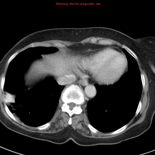 File:Bronchoalveolar carcinoma (BAC) (Radiopaedia 13436-13392 B 42).jpg