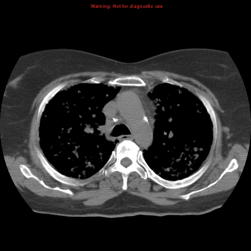 Bronchoalveolar carcinoma (Radiopaedia 13224-13233 Axial non-contrast 16).jpg
