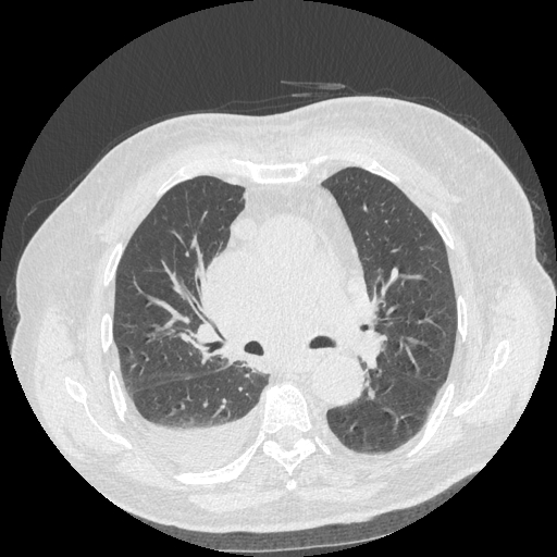 Bronchogenic carcinoma with metastatic lymphadenopathy (Radiopaedia 37671-39569 Axial lung window 25).jpg