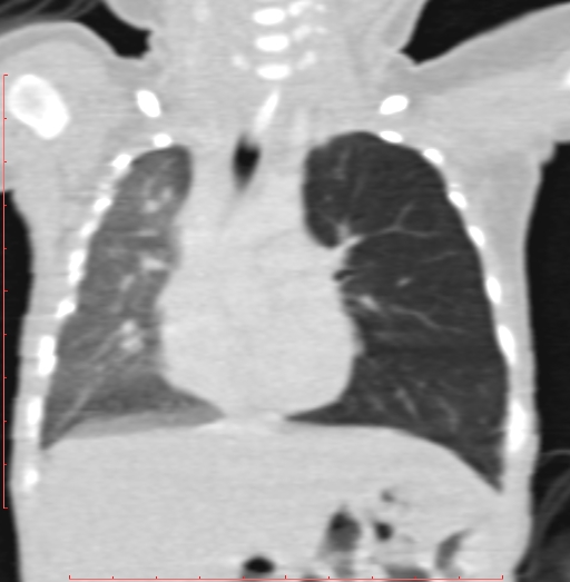 Bronchogenic cyst (Radiopaedia 78599-91409 Coronal lung window 110).jpg
