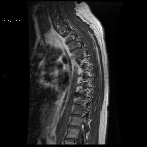 File:Bronchogenic cyst - posterior mediastinal (Radiopaedia 43885-47365 Sagittal T1 14).jpg