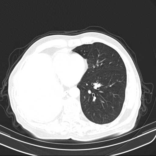 Bronchopleural fistula - postoperative complication (Radiopaedia 21020-20947 Axial lung window 39).jpg