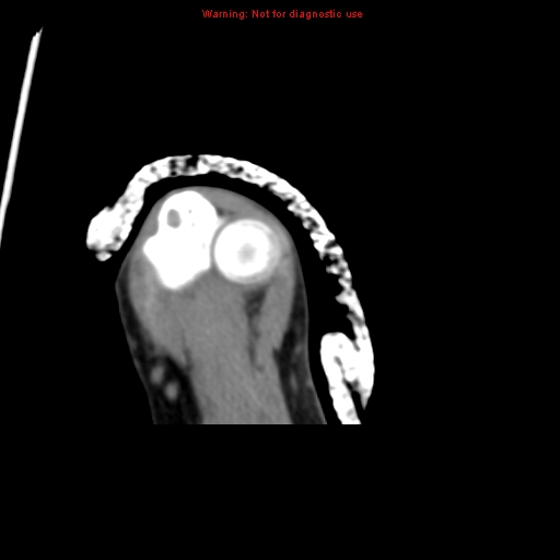 Brown tumor (Radiopaedia 12460-12694 Axial non-contrast 131).jpg