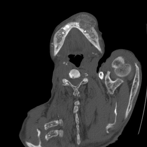 File:Brown tumor with secondary hyperparathyroidism (Radiopaedia 23591-23705 C 9).jpg