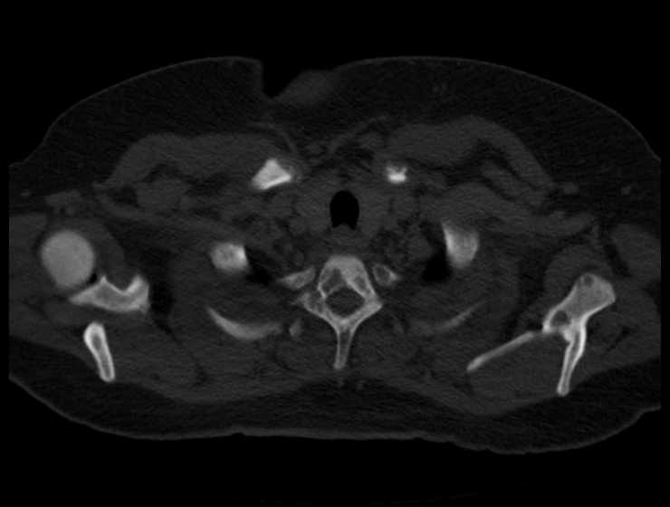 Brown tumors compressing the spinal cord (Radiopaedia 68442-77988 Axial bone window 7).jpg