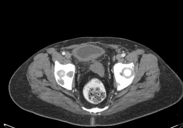 File:Brown tumors compressing the spinal cord (Radiopaedia 68442-77988 E 114).jpg