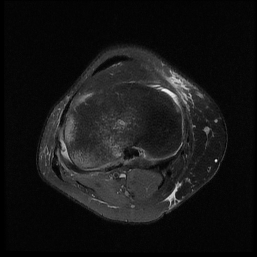 File:Bucket handle meniscus tear (Radiopaedia 56916-63751 Axial PD fat sat 14).jpg