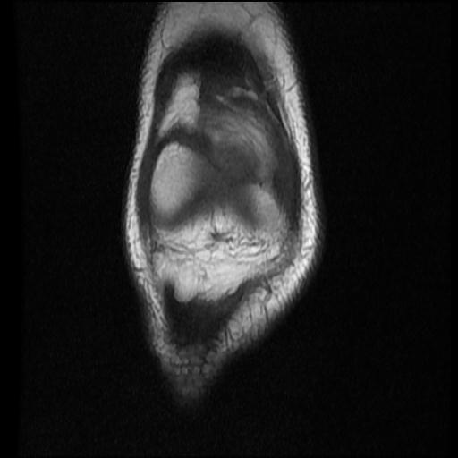 File:Bucket handle tear - lateral meniscus (Radiopaedia 72124-82634 Coronal T1 3).jpg