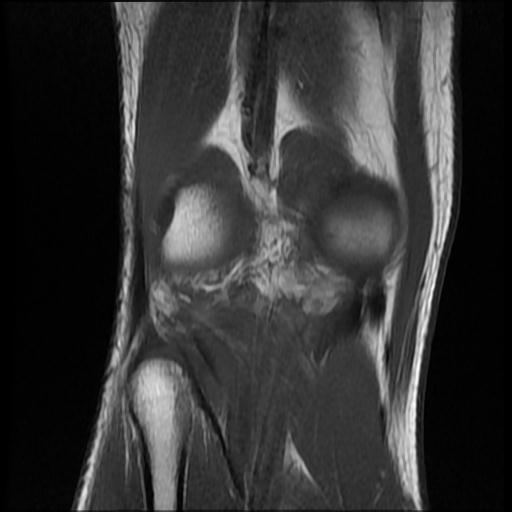 File:Bucket handle tear - medial meniscus (Radiopaedia 69245-79026 Coronal T1 17).jpg