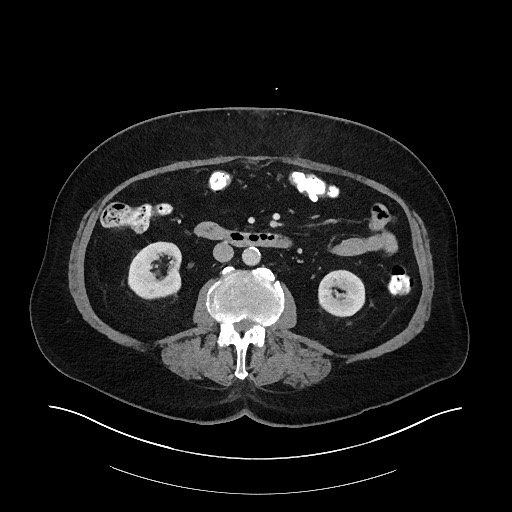 Buried bumper syndrome - gastrostomy tube (Radiopaedia 63843-72575 A 39).jpg