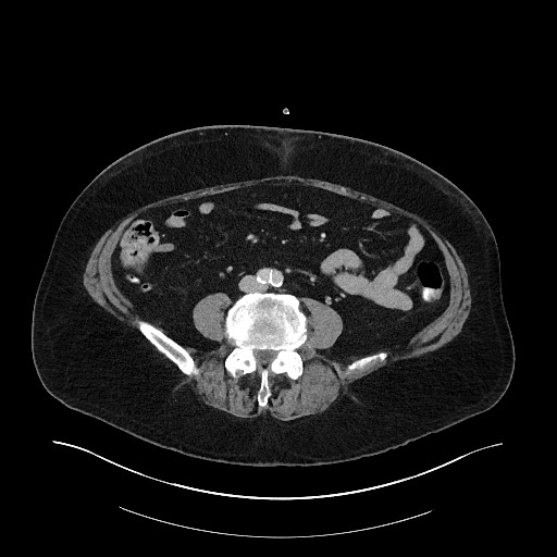 File:Buried bumper syndrome - gastrostomy tube (Radiopaedia 63843-72575 Axial 60).jpg