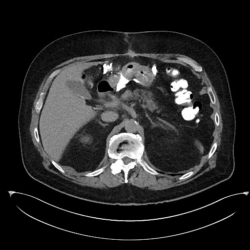 File:Buried bumper syndrome - gastrostomy tube (Radiopaedia 63843-72577 Axial Inject 28).jpg