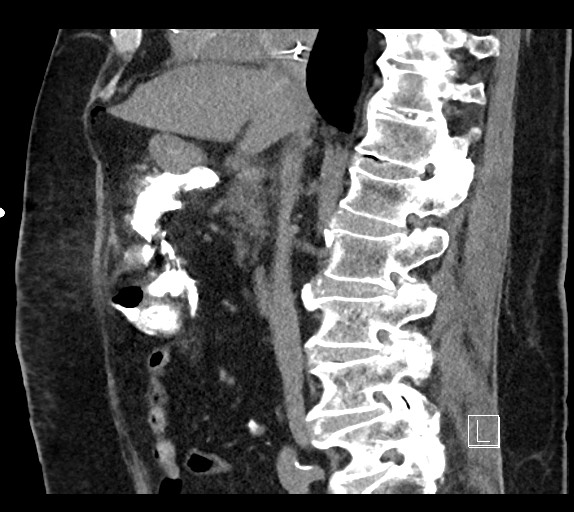 Buried bumper syndrome - gastrostomy tube (Radiopaedia 63843-72577 Sagittal Inject 67).jpg