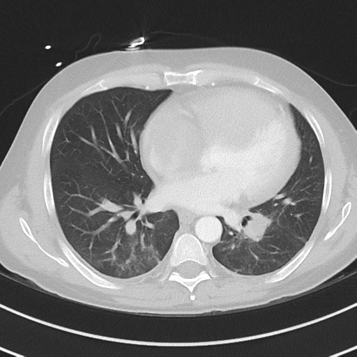 Burkitt lymphoma (Radiopaedia 34686-36121 Axial lung window 29).png