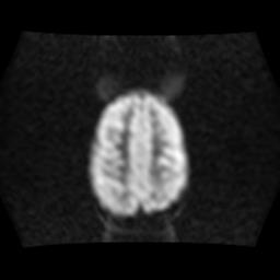 File:Burkitt lymphoma of the orbit. pre and post chemotherapy (Radiopaedia 31214-31929 Axial 33).jpg