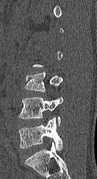 Burst fracture (Radiopaedia 53373-59357 Sagittal bone window 61).jpg