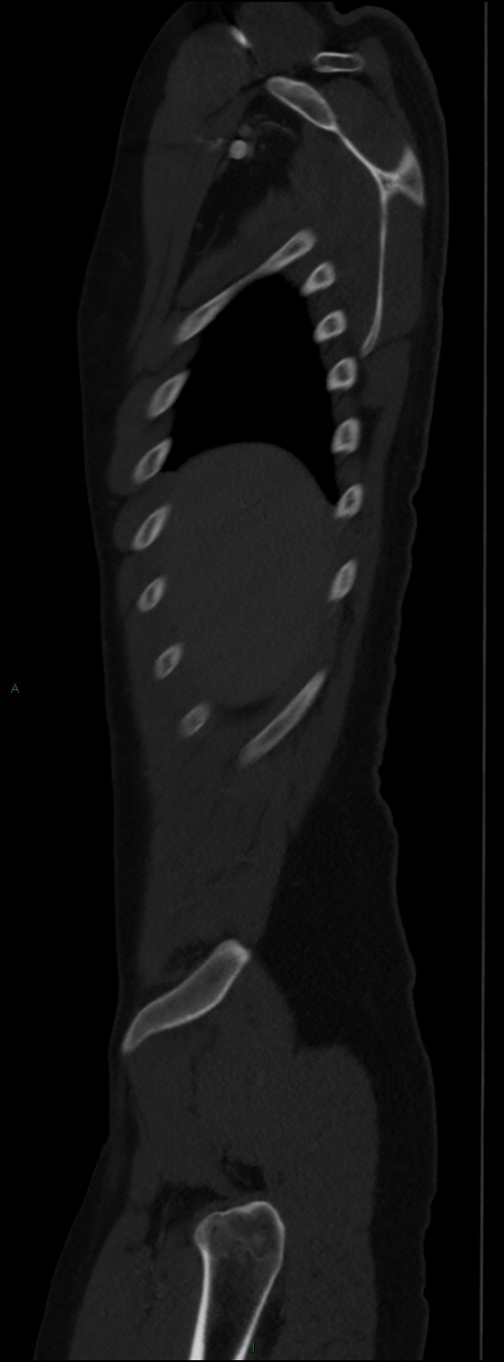 Burst fracture (Radiopaedia 83168-97542 Sagittal bone window 28).jpg