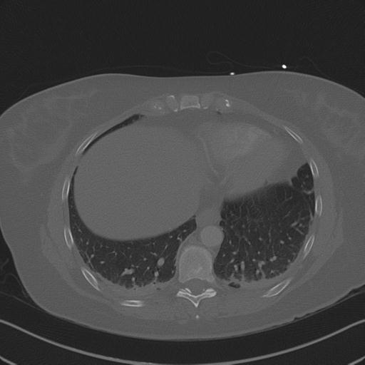 Burst fracture - thoracic spine (Radiopaedia 30238-30865 Axial bone window 67).jpg