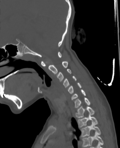 File:Butterfly vertebra (Radiopaedia 77903-90209 Sagittal bone window 33).jpg
