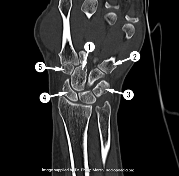 File:CT wrist - coronal (anatomy quiz) (Radiopaedia 60693).jpg