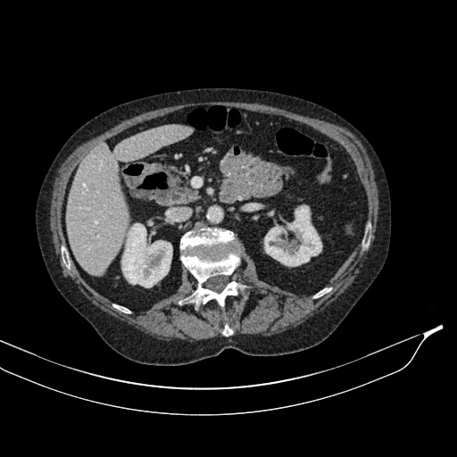 Calcified adrenal glands and Spigelian hernia (Radiopaedia 49741-54988 A 78).jpg