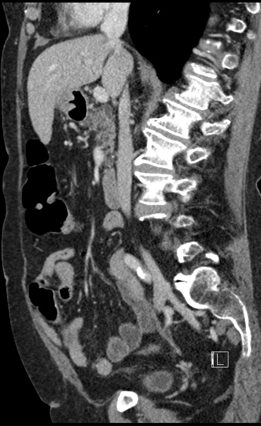 Calcified adrenal glands and Spigelian hernia (Radiopaedia 49741-54988 C 94).jpg