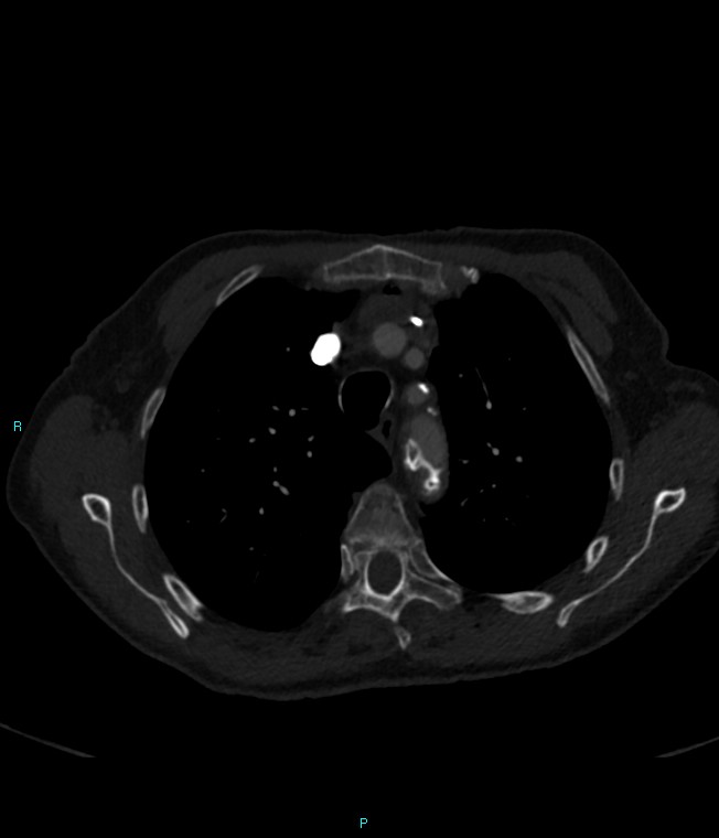Calcified cerebral emboli from left ventricular thrombus (Radiopaedia 84420-99760 Axial bone window 20).jpg