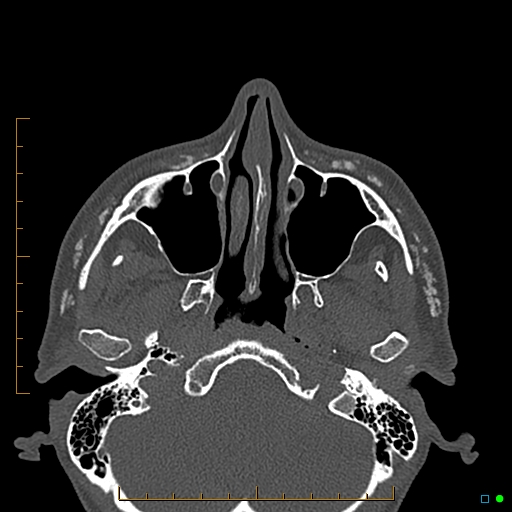 Calcified facial augmentation fillers (Radiopaedia 79514-92679 Axial bone window 23).jpg