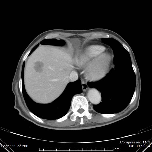 Calcified liver metastases (Radiopaedia 44699-48470 B 9).jpg