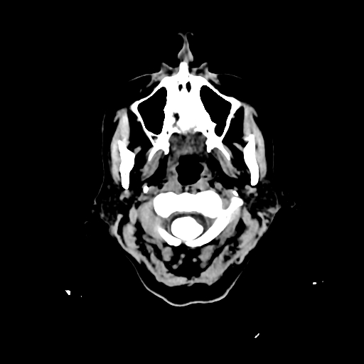 File:Calcified meningioma - cervical canal (Radiopaedia 70136-80171 Axial non-contrast 1).jpg