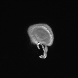 Callosal dysgenesis with interhemispheric cyst (Radiopaedia 53355-59335 Sagittal T1 170).jpg