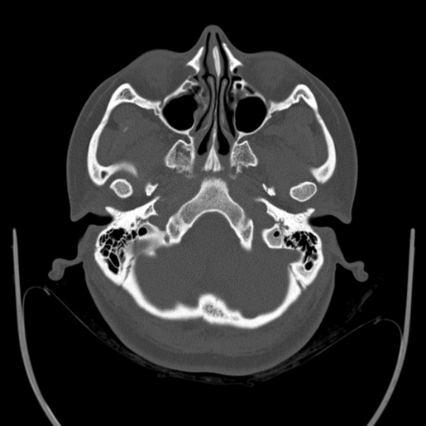 Calvarial osteoma (Radiopaedia 36520-38079 Axial bone window 18).jpg