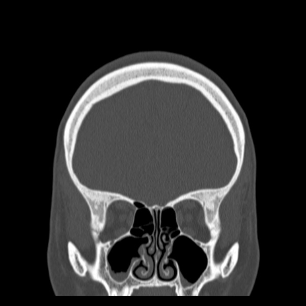 Calvarial osteoma (Radiopaedia 36520-38079 C 25).jpg