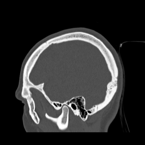 Calvarial osteoma (Radiopaedia 36520-38079 Sagittal bone window 88).jpg