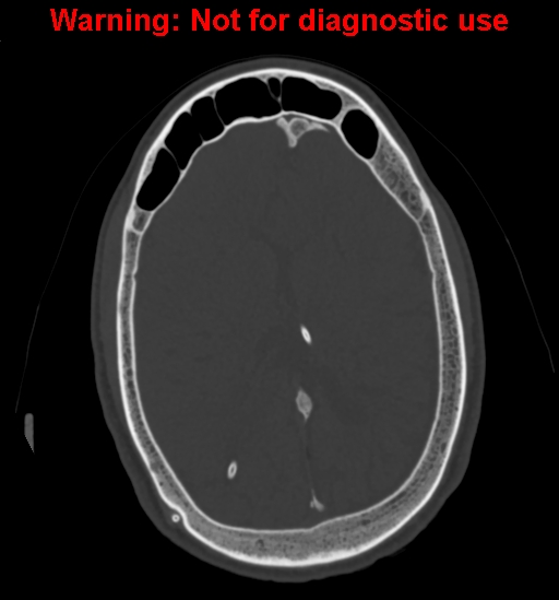 Calvarial thickening from chronic shunting (Radiopaedia 60079-67637 Axial bone window 114).jpg