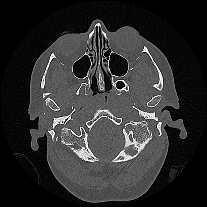 Canal up mastoidectomy (Radiopaedia 78108-90638 Axial bone window 24).jpg