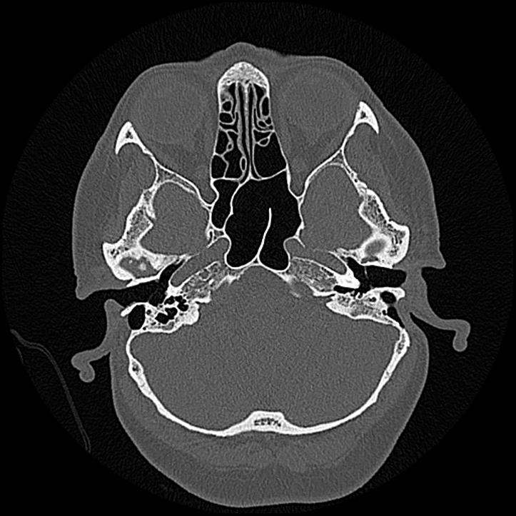 Canal up mastoidectomy (Radiopaedia 78108-90638 Axial bone window 58).jpg