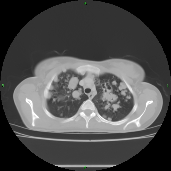 File:Cannon ball metastases - synovial sarcoma (Radiopaedia 26135-26271 Axial lung window 9).jpg