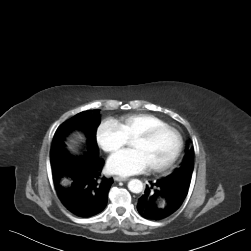 Cannonball metastases from endometrial cancer (Radiopaedia 42003-45031 E 5).png