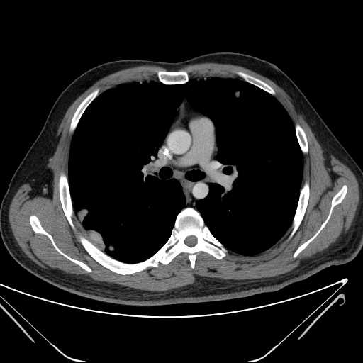 File:Cannonball pulmonary metastases (Radiopaedia 67684-77101 D 121).jpg
