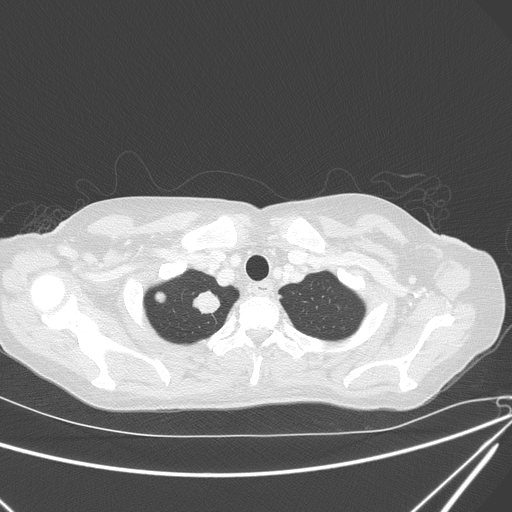 Canonball lung metastasis (Radiopaedia 77634-89837 Axial lung window 21).jpg