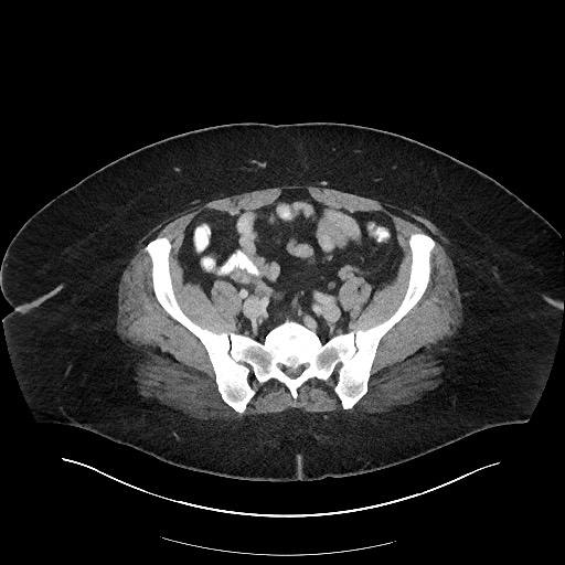 Carcinoid tumor - terminal ileum (Radiopaedia 60931-68739 A 99).jpg