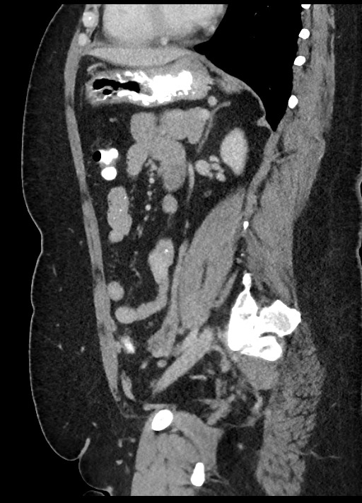 Carcinoid tumor - terminal ileum (Radiopaedia 60931-68739 C 33).jpg