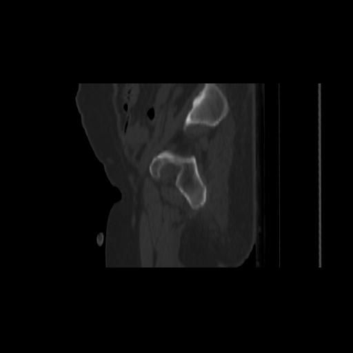 Carcinoma cervix- brachytherapy applicator (Radiopaedia 33135-34173 Sagittal bone window 27).jpg