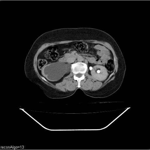 File:Carcinoma cervix- recurrence (Radiopaedia 34702-36137 Axial C+ delayed 11).jpg